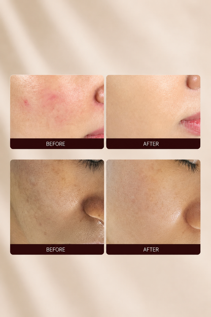 Pureluma Pro Red Light Therapy Face Mask